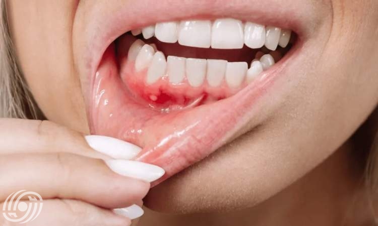 ما الذي يسبب "خرّاج" الأسنان؟