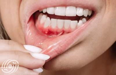 ما الذي يسبب "خرّاج" الأسنان؟