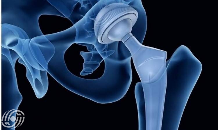 إيران تحقق تقنية زراعة العظام القابلة للامتصاص