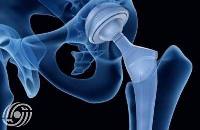 إيران تحقق تقنية زراعة العظام القابلة للامتصاص إيران تحقق تقنية زراعة العظام القابلة للامتصاص