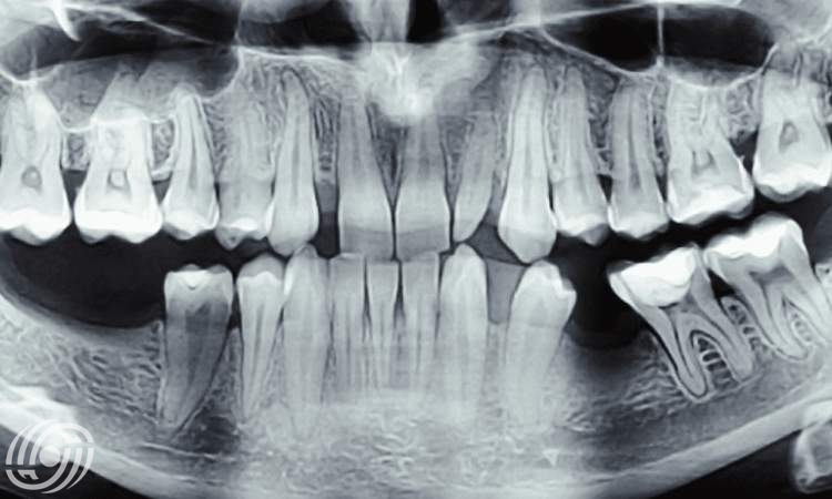 هل أشعة الأسنان آمنة أثناء الحمل ؟