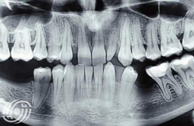 هل أشعة الأسنان آمنة أثناء الحمل ؟